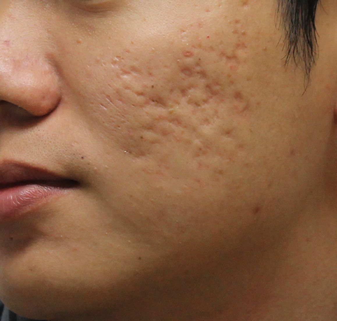 Best Ways To Treat Acne Scarring At Home