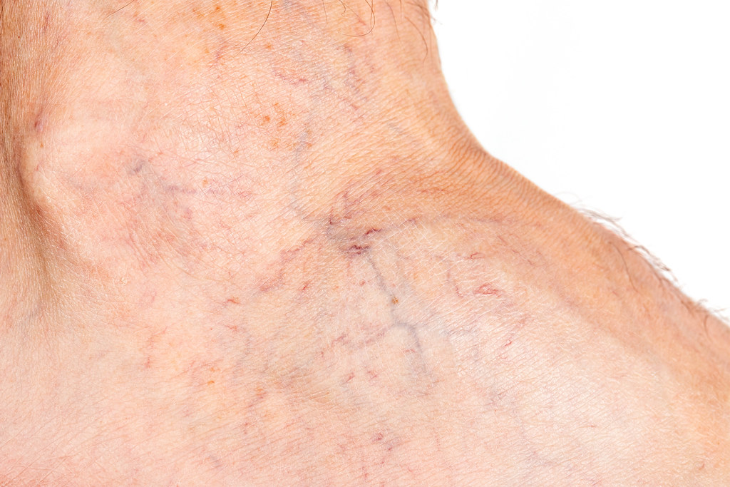 5 At Home Remedies For Spider Veins